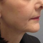 Ultherapy Before & After Patient #309
