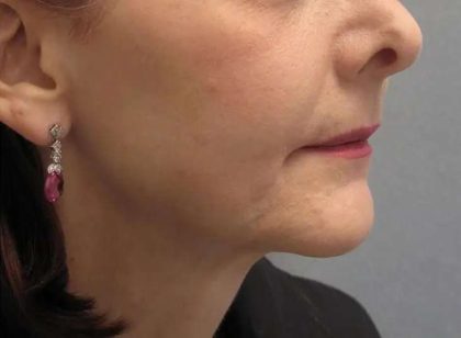 Ultherapy Before & After Patient #309
