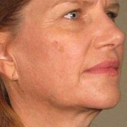 Ultherapy Before & After Patient #312
