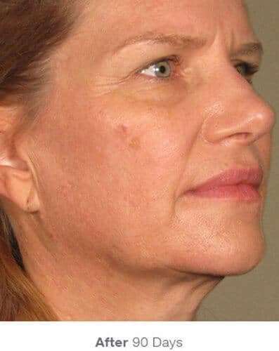 Ultherapy Before & After Patient #312