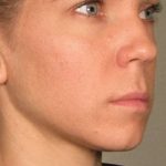 Ultherapy Before & After Patient #315