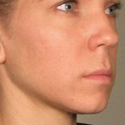 Ultherapy Before & After Patient #315