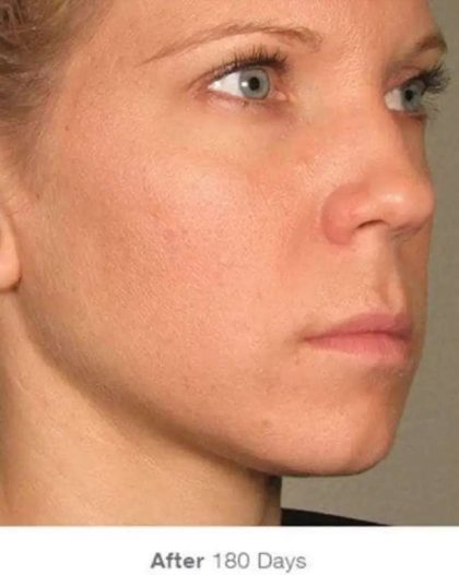 Ultherapy Before & After Patient #315