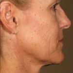 Ultherapy Before & After Patient #318