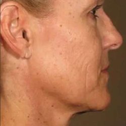 Ultherapy Before & After Patient #318