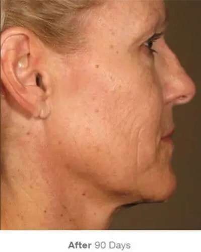 Ultherapy Before & After Patient #318