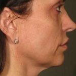 Ultherapy Before & After Patient #321