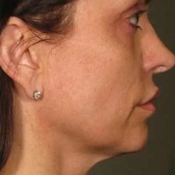 Ultherapy Before & After Patient #321