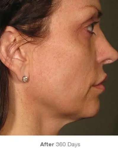 Ultherapy Before & After Patient #321