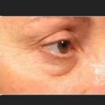Ultherapy Before & After Patient #324