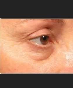 Ultherapy Before & After Patient #324