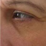 Ultherapy Before & After Patient #327