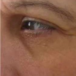 Ultherapy Before & After Patient #327