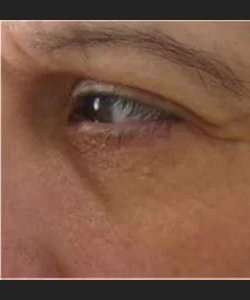 Ultherapy Before & After Patient #327