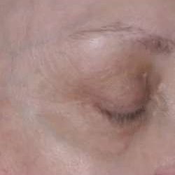 Ultherapy Before & After Patient #330