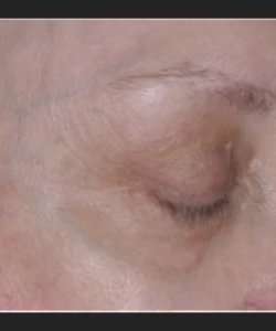 Ultherapy Before & After Patient #330