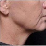 Ultherapy Before & After Patient #333