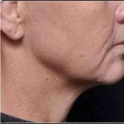 Ultherapy Before & After Patient #333