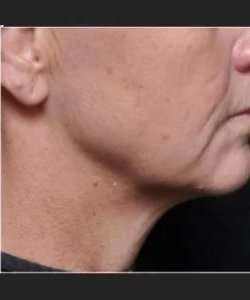 Ultherapy Before & After Patient #333
