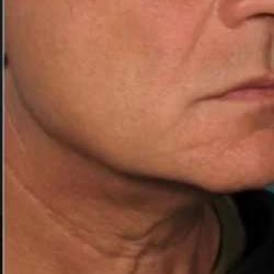 Ultherapy Before & After Patient #336