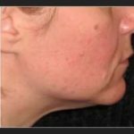 Ultherapy Before & After Patient #339