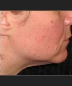 Ultherapy Before & After Patient #339