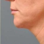 Ultherapy Before & After Patient #342