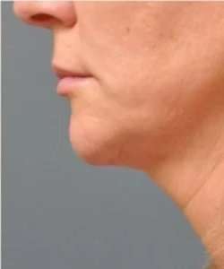 Ultherapy Before & After Patient #342