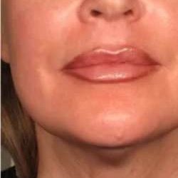 Ultherapy Before & After Patient #345