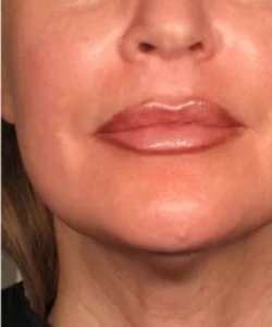 Ultherapy Before & After Patient #345