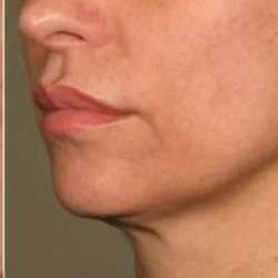 Ultherapy Before & After Patient #348