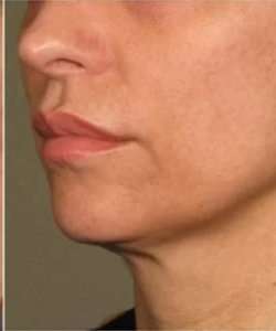 Ultherapy Before & After Patient #348