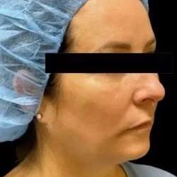 Ultherapy Before & After Patient #351