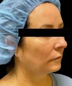 Ultherapy Before & After Patient #351