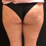 Cellulaze Before & After Patient #362