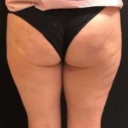 Cellulaze Before & After Patient #362