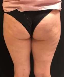 Cellulaze Before & After Patient #362