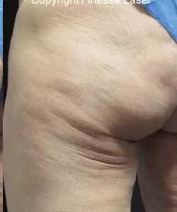 Cellulaze Before & After Patient #365