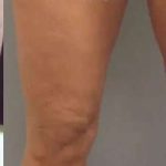 Cellulaze Before & After Patient #368