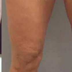 Cellulaze Before & After Patient #368