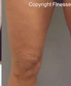Cellulaze Before & After Patient #368