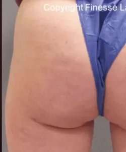 Cellulaze Before & After Patient #371
