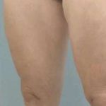 Cellulaze Before & After Patient #374