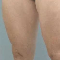 Cellulaze Before & After Patient #374