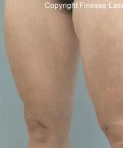 Cellulaze Before & After Patient #374