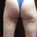 Cellulaze Before & After Patient #377
