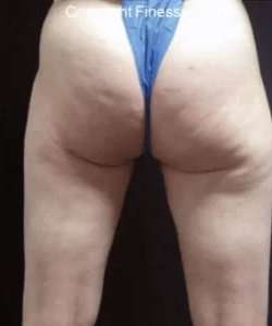 Cellulaze Before & After Patient #377