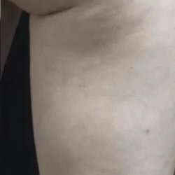 Cellulaze Before & After Patient #380