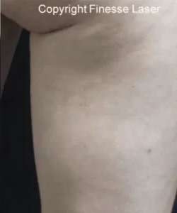 Cellulaze Before & After Patient #380