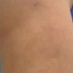 Cellulaze Before & After Patient #395